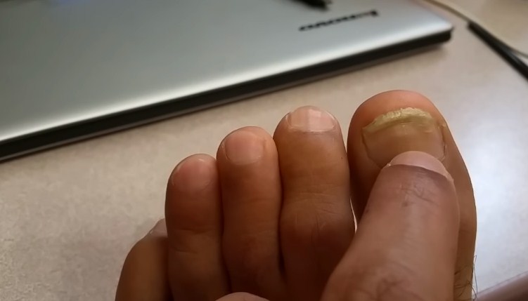 The 7 Best Toenail Fungus Treatments of 2022