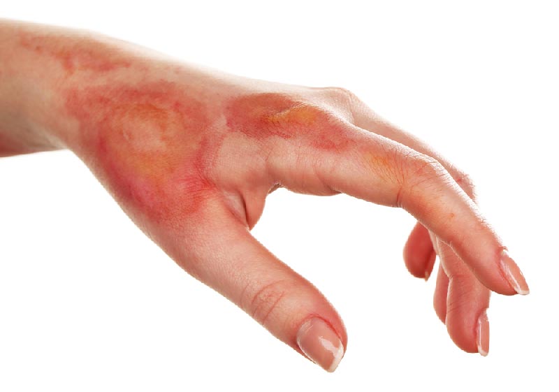 Using Colloidal Silver for Burns 11 Colloidal silver and burns
