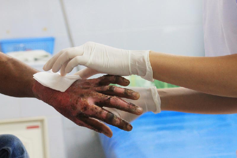 Using Colloidal Silver for Burns 12 Using Colloidal Silver for Burns 1