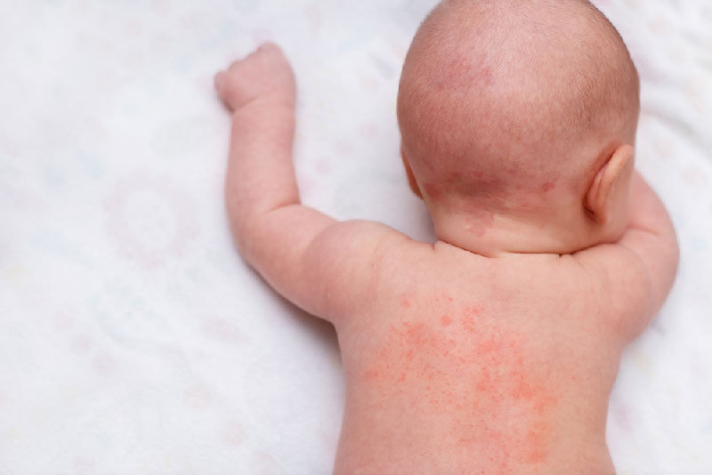 What causes Baby Eczema